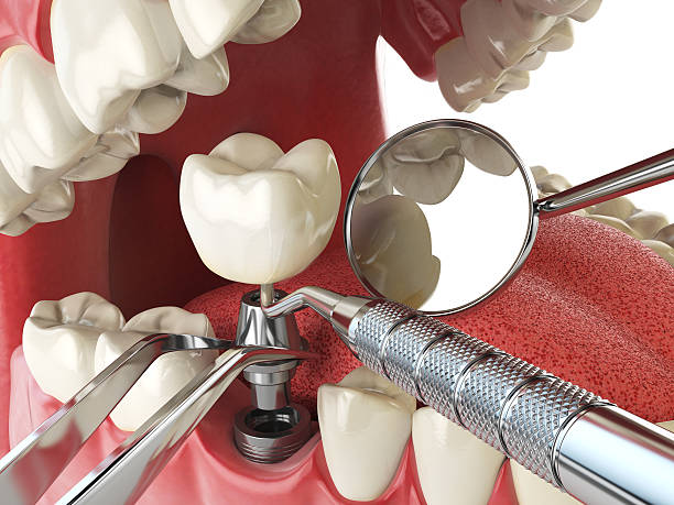 Best Emergency Tooth Extraction in Markle, IN